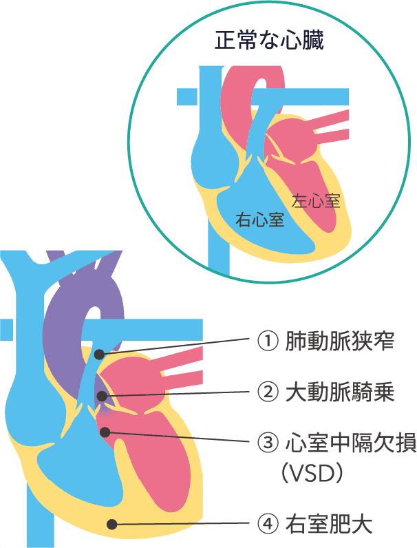ファロー四徴症について