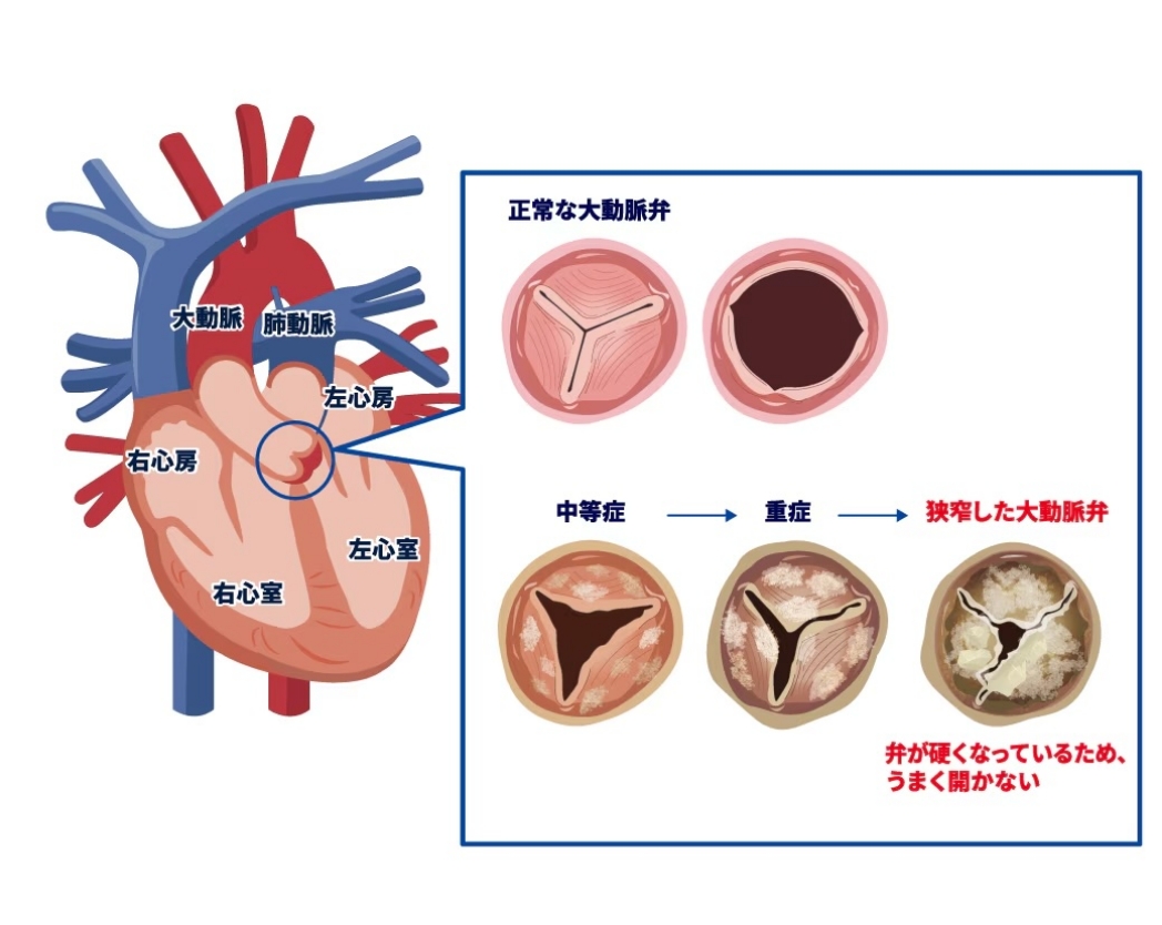 大動脈弁狭窄症とは